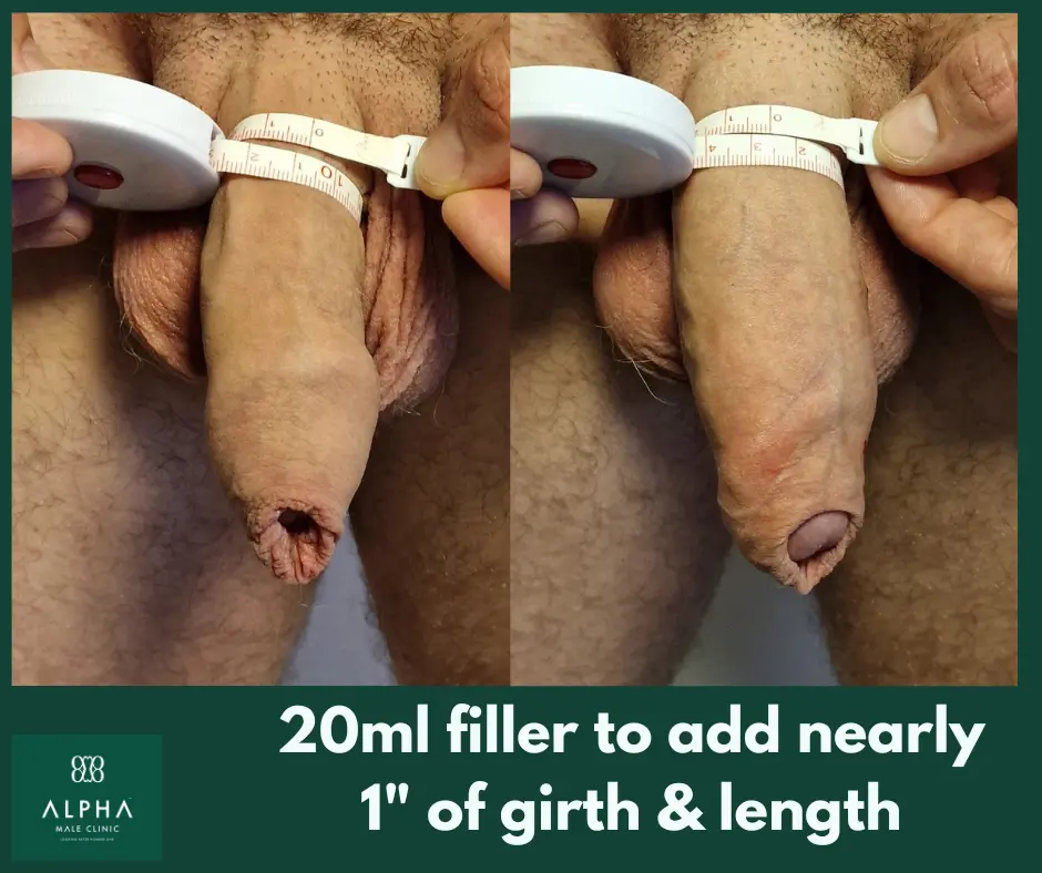 Penis Filler