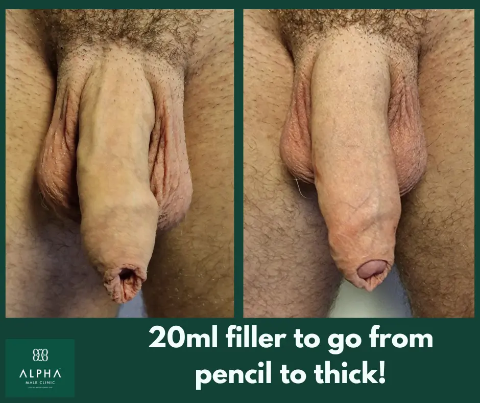 Penis Filler