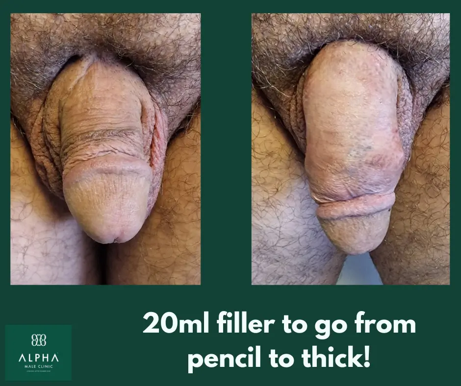 Penis Filler