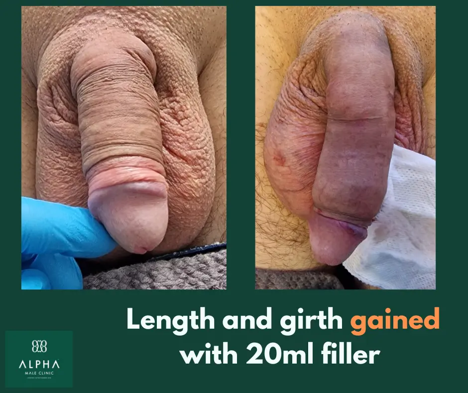Penis Filler